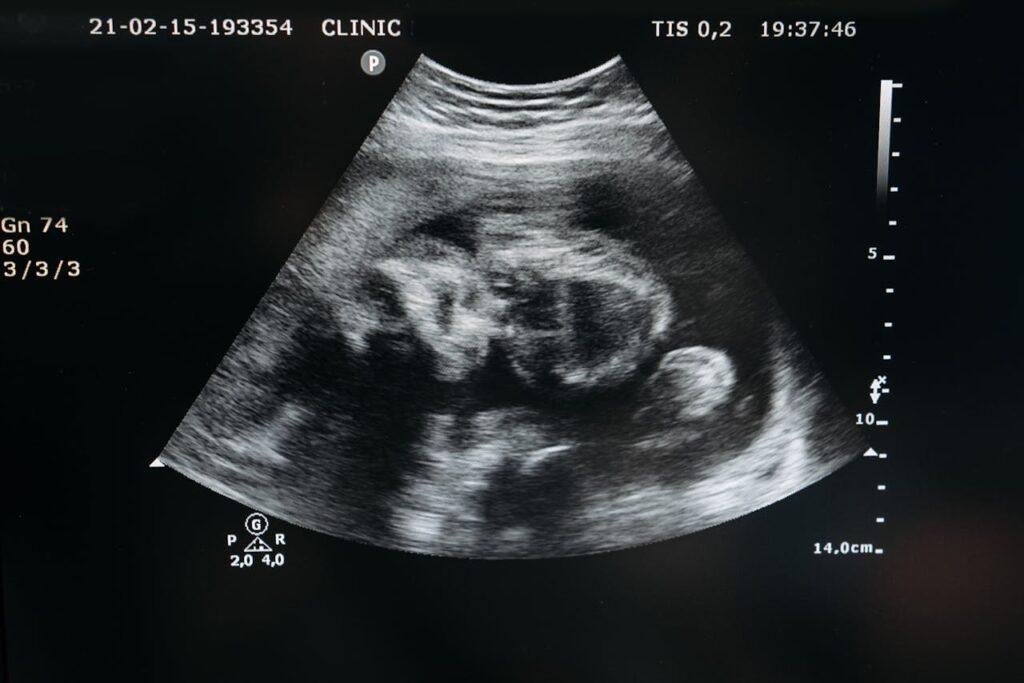 Ultrasound scan showing the image of an unborn child in the womb, highlighting pregnancy and healthcare.