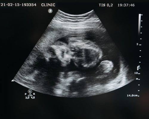 Ultrasound scan showing the image of an unborn child in the womb, highlighting pregnancy and healthcare.
